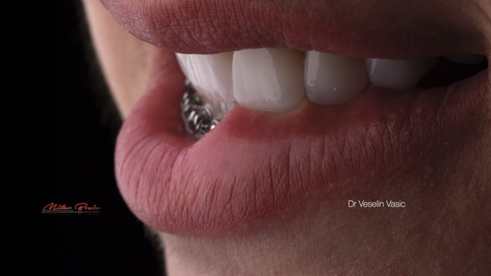 Dentalna fotografija 032